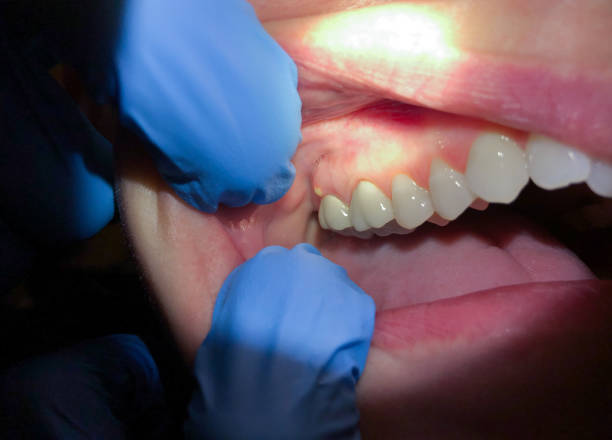 Best Emergency Wisdom Teeth Removal in Pearl River, NY